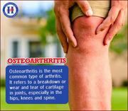 Homeopathy treatment for Arthritis