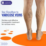 Varicose Veins Homeopathy Treatments in Bangalore -Rich Care 