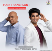 Affordable hair transplant in Bengaluru